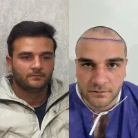 کاشت مو/کاشتمو/کاشت ریش یک مرحله ای