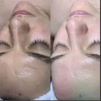 پاکسازی پوست|خدمات آرایشگری و زیبایی|اسلامآباد غرب, |دیوار