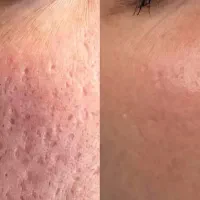 پاکسازی پوست فشیال پوست