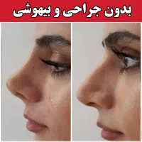 آف فرمدهی بینی بدون عمل جراحی پزشک پوست مو زیبایی|خدمات آرایشگری و زیبایی|مشهد, هفت تیر (آب و برق)|دیوار