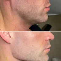 جشنواره پاییزه تزریق ژل بوتاکس مزوژل درکلینیک پزشک|خدمات آرایشگری و زیبایی|اصفهان, وحید|دیوار