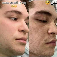 جشنواره درمان تضمینی لک و کک و مک / فقط در 1 جلسه