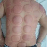 حجامت معجزه میکنه|آرایشی، بهداشتی، درمانی|بندر کنگان, |دیوار