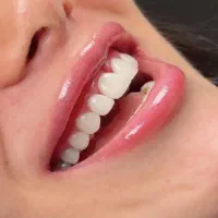 کامپوزیت و پر کردن دندان تضمینی  توسط پزشک