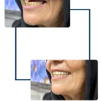 دندان مصنوعی اقساط و بیمه|خدمات آرایشگری و زیبایی|کرمان, |دیوار