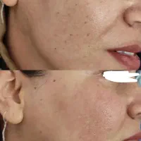 رفع کک و مک و لک . خال . اسکین تگ در یک جلسه