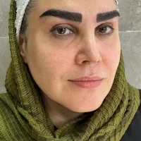 کاشت ابروی مادام العمر در کلینیک تخصصی پوست و مو