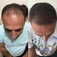 تقویت کننده مو و ضد ریزش قویی