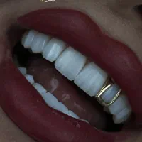 کامپوزیت لمینت روکش طلا