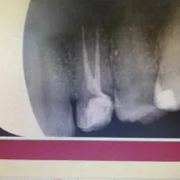 درمان ریشه دندان