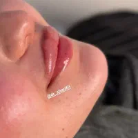 جشنواره بوتاکس و ژل فیلر توسط دکتر شریفی