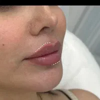 فیلر