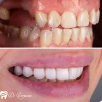 جشنواره اثتثنایی ایمپلنت|خدمات آرایشگری و زیبایی|شیراز, خلدبرین|دیوار