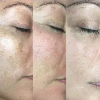 فیشیال و پاکسازی پوست|خدمات آرایشگری و زیبایی|شیراز, قصرالدشت|دیوار