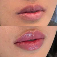 فیلر بوتاکس لیزر موهای زائد فیشال فشیال|خدمات آرایشگری و زیبایی|تهران, سبلان (لشگر)|دیوار