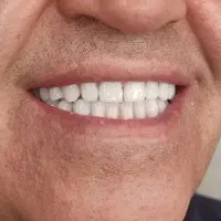 ساخت و تعمیر دندان مصنوعی/مواد آلمانی/نقد و اقساط|خدمات آرایشگری و زیبایی|چناران, |دیوار