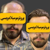 پروتز مو مردانه و زنانه