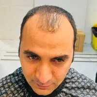 کاشت مو ، ابرو و ریش و مشاور پذیرش|استخدام درمانی، زیبایی، بهداشتی|شیراز, معالی‌آباد|دیوار