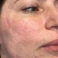 جشنواره تخفیف ویژه CO2 فرکشنال در کلینیک هُلو-کرج|خدمات آرایشگری و زیبایی|کرج, عظیمیه|دیوار