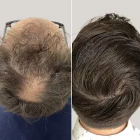 کاشت نکن اول اینو ببین