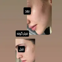 تزریق ژل با قیمت مناسب وبا کیفیت|خدمات آرایشگری و زیبایی|برازجان, |دیوار