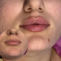 تزریق ژل و بوتاکس