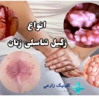 درمان زگیل تناسلی بصورت کاملا گیاهی