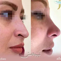 اف ویژه جراحی بینی در اهواز|خدمات آرایشگری و زیبایی|سوسنگرد, |دیوار