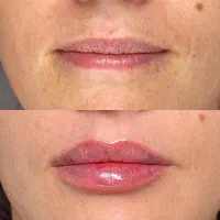 فیلر بادی/کانتورینگ صورت/تزریق چربی/بوتاکس/ژل لب|خدمات آرایشگری و زیبایی|تهران, تهرانپارس غربی|دیوار
