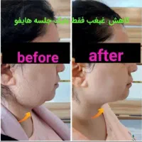 هایفوتراپی،رفع غبغب،لیزر،امبدینگ لاغری،prp|خدمات آرایشگری و زیبایی|سیرجان, |دیوار