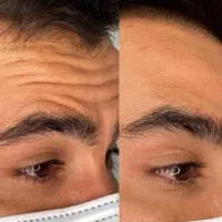 تزریق بوتاکس توسط پزشک با ۴۰درصد تخفیف