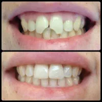 خدمات کامپوزیت دندان و زیبایی دندان|خدمات آرایشگری و زیبایی|زنجان, |دیوار