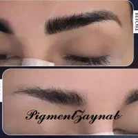 میکروبلیدینگ و ریموو تک جلسه ای