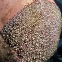 کاشت مو و ابرو با جدید ترین دستگاه های روز دنیا|خدمات آرایشگری و زیبایی|یاسوج, |دیوار