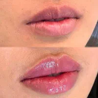 مزو،بوتاکس،چربی،فیلر،جراحی زیبایی صورت وبدن|خدمات آرایشگری و زیبایی|تهران, نارمک|دیوار