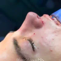 رینوپلاستی(جراحی بینی)فقط37میلیون با شرایط اقساط