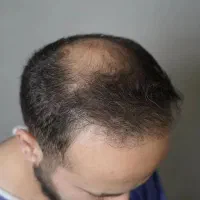 کاشت مو|خدمات آرایشگری و زیبایی|سقز, |دیوار