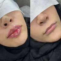تزریقات زیبایی و فیشیال
