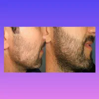 سرم رشد ریش و سبیلت این جاست
