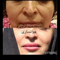 of تا فرداژل و بوتاکس مزو ژل مزو تراپی  prp|خدمات آرایشگری و زیبایی|مشهد, امام رضا (ع)|دیوار