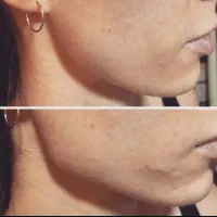 ژل و بوتاکس|خدمات آرایشگری و زیبایی|چناران, |دیوار