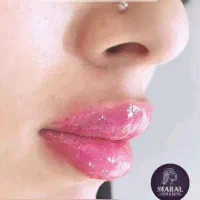 جشنواره زیبایی لیزر فیلر بوتاکس زگیل خال|خدمات آرایشگری و زیبایی|تهران, یافت آباد شمالی|دیوار