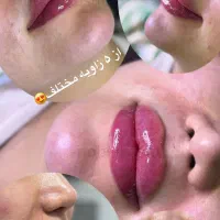 تزریق تخصصی ژل و بوتاکس وپی آرپی صورت