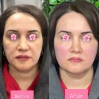 ژل بوتاکس فیلر فیشیال مزوتراپی توسط پزشک مجرب|خدمات آرایشگری و زیبایی|شهریار, شهریار|دیوار