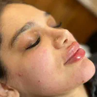 تزریق ژل بوتاکس مزوتراپی پاکسازی جوانسازی|خدمات آرایشگری و زیبایی|تهران, نیروی هوایی (پیروزی)|دیوار