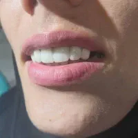 جشنواره ی کاشت ایمپلنت دندانی