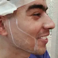 فیلر سی سی۳۳۰ بلفاروپلاستی ۶/۹۰۰ بوتاکس ۲۵۰|خدمات آرایشگری و زیبایی|تهران, صادقیه|دیوار