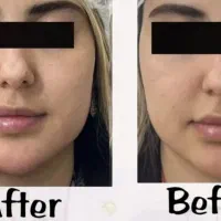 مدل فیلر صورت در کلینیک نوا|خدمات آرایشگری و زیبایی|شیراز, ستارخان|دیوار