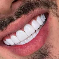 کامپوزیت لبه شیشه ای و بلیچینگ