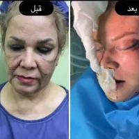 لیفت شقیقه ،بلفارو ،غبغب وغیره|خدمات آرایشگری و زیبایی|اهواز, کیانپارس |دیوار